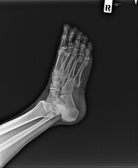 Film x-ray of  ankle . Lateral view