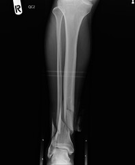 Film x-ray of facture ankle . Lateral view in red area
