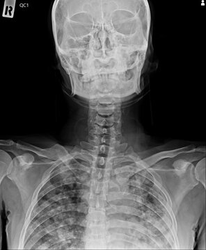x ray of a human skull and spine
