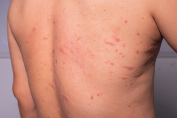 man's back was covered with many red wounds. insect allergy full back rash skin disease