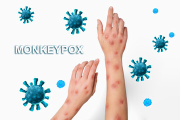 Woman with rash suffering from monkeypox virus on white background, closeup
