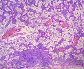 Photomicrograph of Stomach Adenocarcinoma. Gastric Adenocarcinoma.