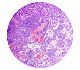 Photomicrograph of Stomach Adenocarcinoma. Gastric Adenocarcinoma.
