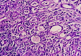 Photomicrograph of Stomach Adenocarcinoma. Gastric Adenocarcinoma.