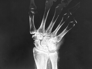 X-ray image of carpals bone ,AP view