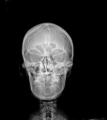 x ray of human skull