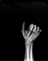film X-ray fracture finger