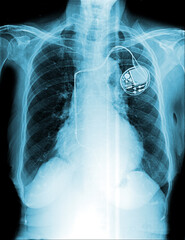 Film chest x-ray show pacemaker implantation in red area