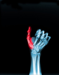 film x-ray finger fracture in the red area