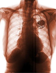 Film chest x-ray show pacemaker implantation in red area