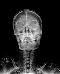 human skull x ray