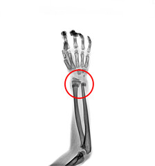 film X-ray fracture forearm in the red circle