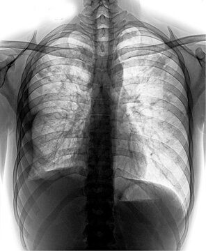 Bronchiectasis . X-ray Chest Show Multiple Lung Bleb And Cyst Due To Chronic Infection 