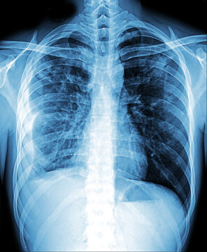 Bronchiectasis . X-ray chest show multiple lung bleb and cyst due to chronic infection 