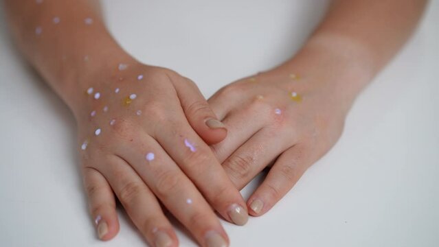Close-up female palms with monkeypox rash tapping fingers on white table. Unrecognizable ill Caucasian woman with symptoms of contagious infectious illness sitting indoors waiting