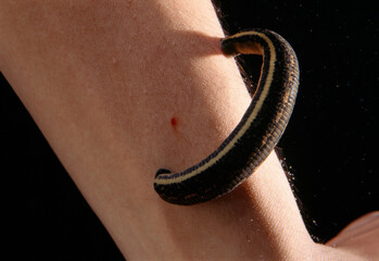 A medical leech (Hirudo medicinalis) feeding on an arm.  They are currently use d by doctors to help estalish circulation after limb reattachments.; U.S.A.
