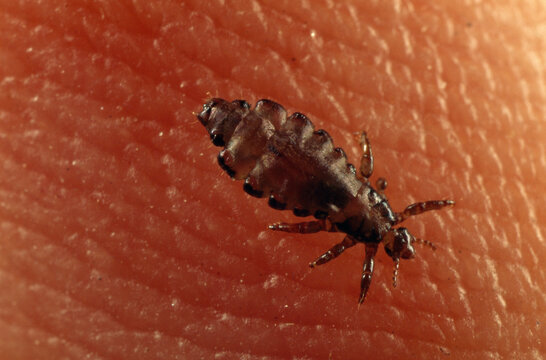Head lice nidirect