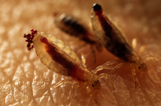 Body lice (Pediculus humanus) feeding on a person's blood.  Often found on peop le who neglect personal hygiene.; U.S.A.