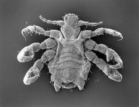 Scanning Electron Microscopic View Of A Crab Louse (Pthirus Pubis).  It Is Magn Ified 30x.  It Is Mainly Spread In Humans By Sexual Contact.; U.S.