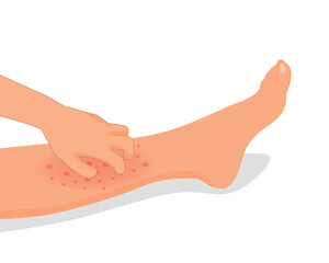 Woman hand scratching her itchy leg with rash dry skin because of allergic reaction