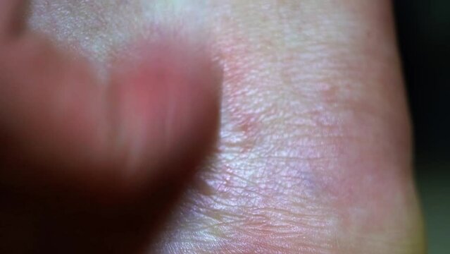 Hookworm infected foot extreme  macro closeup on heel scratching the red irritated skin with a finger where the larvae parasite has been crawling inside of the skin causing itches and pain.