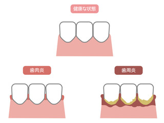 健康な歯、歯周病、歯肉炎のイラスト2