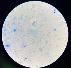 red cell mycobacterium tuberculosis.