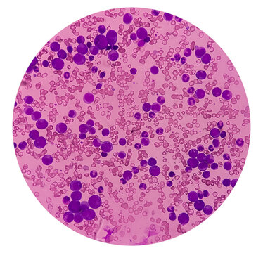 Chronic myeloid leukemia or CML(chronic phase) with microcytic hypochromic anemia. Type of blood cancer. chronic myelogenous leukemia.