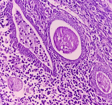 Uterus wall consist pyometra with cervicitis, photomicrograph show dense infiltration of polymorphs, lymphocytes, histiocytes and necrotic material.
