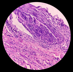 Cheek cyst(biopsy): Microscopic view of Mucous retention cyst, benign pathologic lesion.