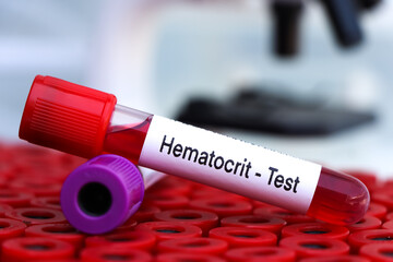Hematocrit test to look for abnormalities from blood