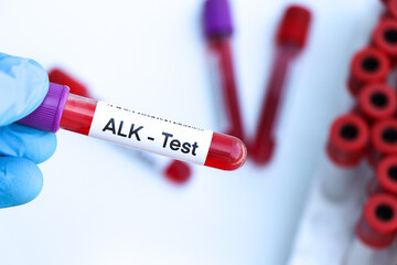 ALK test to look for abnormalities from blood