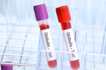 Globulin test to look for abnormalities from blood