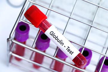 Globulin test to look for abnormalities from blood