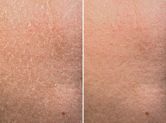 Collage demonstrating comparison of dry and moisturized human skin, closeup