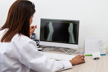 Traumatologist female doctor reviewing an x-ray of a patient's hands. Skeleton bone disease exam and medic aid. Career concept.