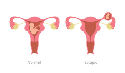 ectopic pregnancy pregnancy problem with comparison with normal pregnancy with modern flat style - obrazy, fototapety, plakaty