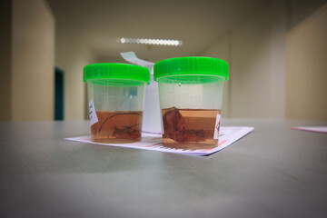  Tissue samples are placed in formalin for subsequent examination by a pathologist