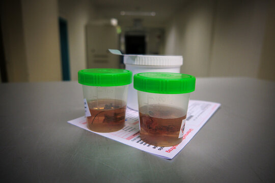  Tissue samples are placed in formalin for subsequent examination by a pathologist