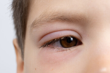 Obraz premium Eye of a child with conjunctivitis, inflammation of the conjunctiva, close-up.