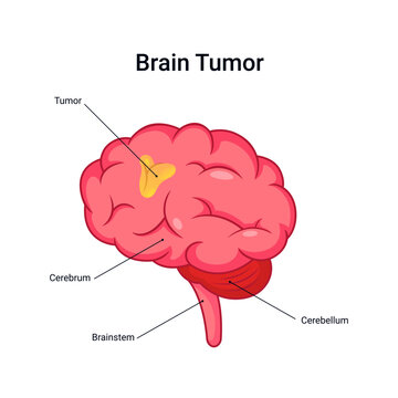 Brain tumor disease diagram, medical illustration