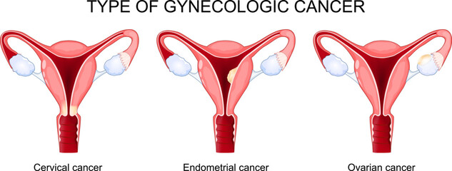 Type of gynecologic cancer. Ovarian, Endometrial, and Cervical cancer.