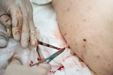 Experienced doctor in gloves on his hands with help of surgical forceps pulls varicose node through small puncture on leg. Close-up of the surgeon's work to remove varicose veins in a patient's leg