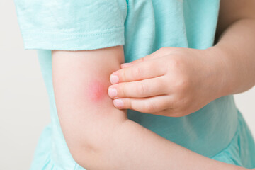 Toddler girl fingers itching red bite of mosquito on arm skin. Closeup.