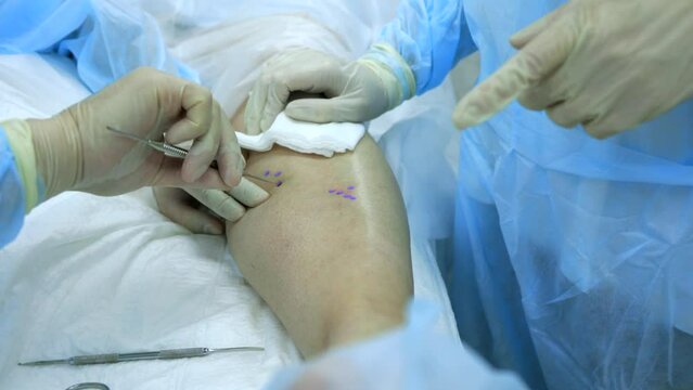 Using a venoextractor, the surgeon makes a puncture on the marked leg of the patient to access the affected vein. Moment of creating a minimal hole in the patient's leg to remove the varicose node
