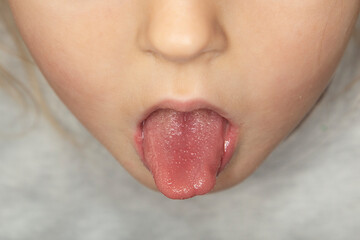Strawberry tongue of a small child with scarlet fever caused by group A streptococcus
