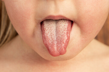 Strawberry tongue of a small child with scarlet fever caused by group A streptococcus - 555715287
