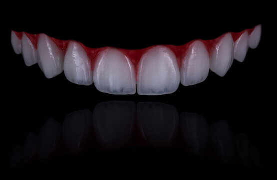 dental work of veneer teeth model