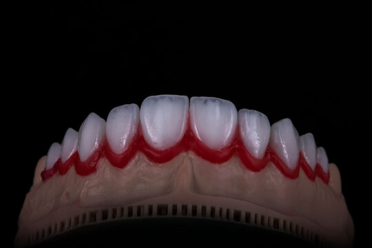 dental work of veneer teeth model