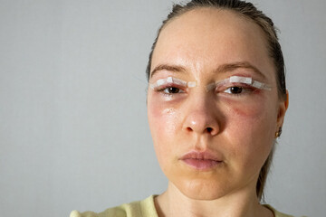 Fototapeta premium woman face after plastic surgery, blepharoplasty operation, swelling eye bags, incisions with removable stitches, swollen skin and bruised eyelids. Cosmetic surgery to remove excess skin or fat 